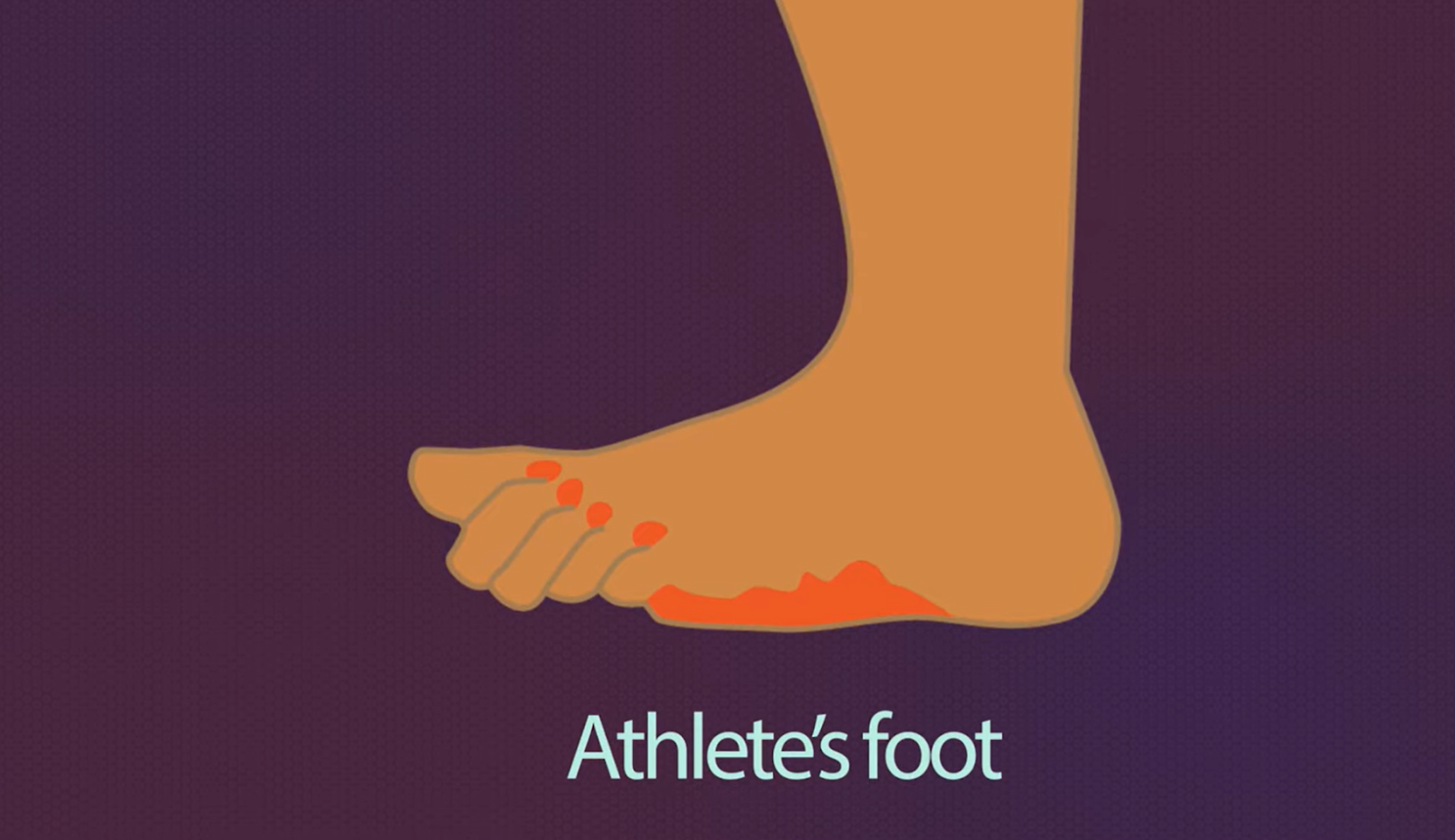 foot with red spots, labeled "Athlete's foot," on a purple background